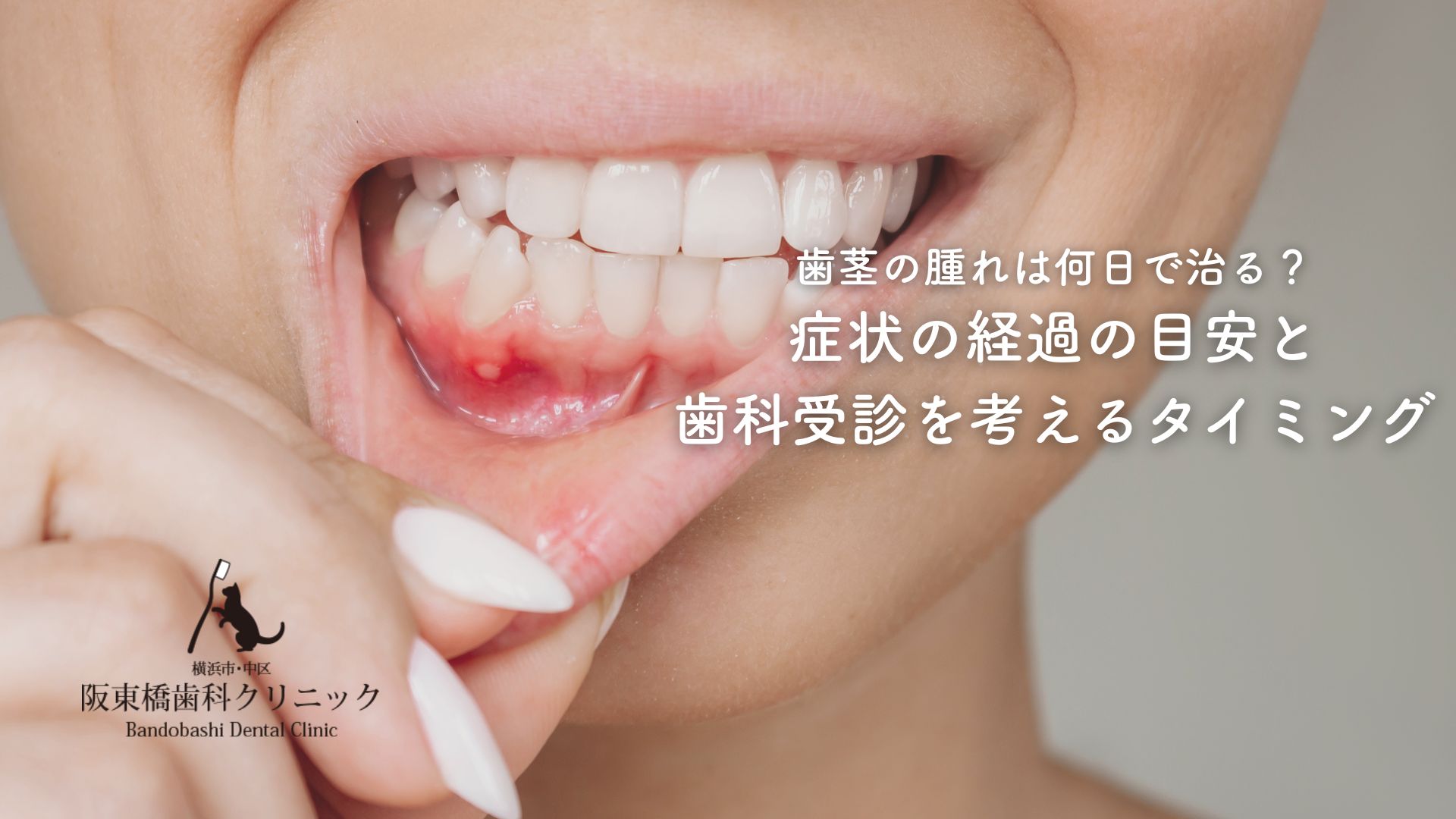 歯茎の腫れは何日で治る？症状の経過の目安と歯科受診を考えるタイミング