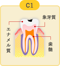 軽度のむし歯