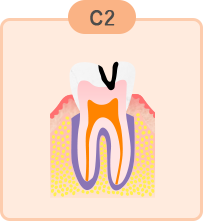中度のむし歯