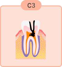 重度のむし歯