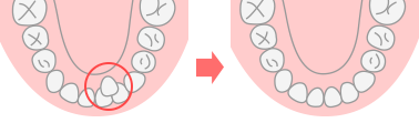 過剰歯の抜歯