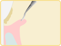 歯肉剥離掻把術の流れ02