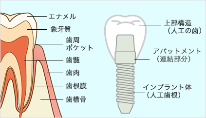 インプラントの構造